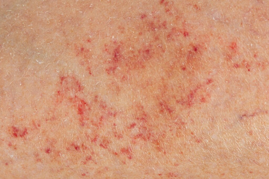 Petechiae on the skin